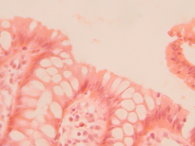 Imagen histolgica. Biopsia de colon. - <div style=